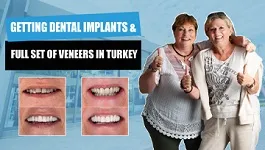 Getting-full-set-of-veneers-in-Turkey-with-dental-implants