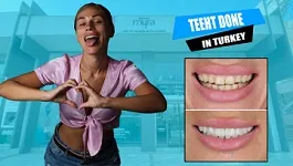 Teeth-Turkey-emax-laminate-veneer