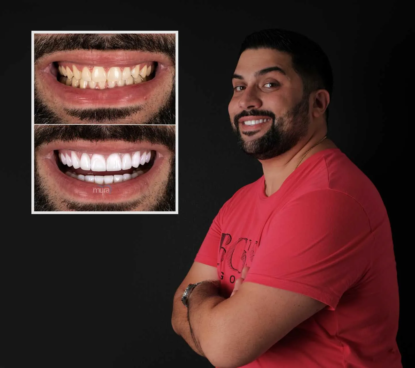 porcelain veneers