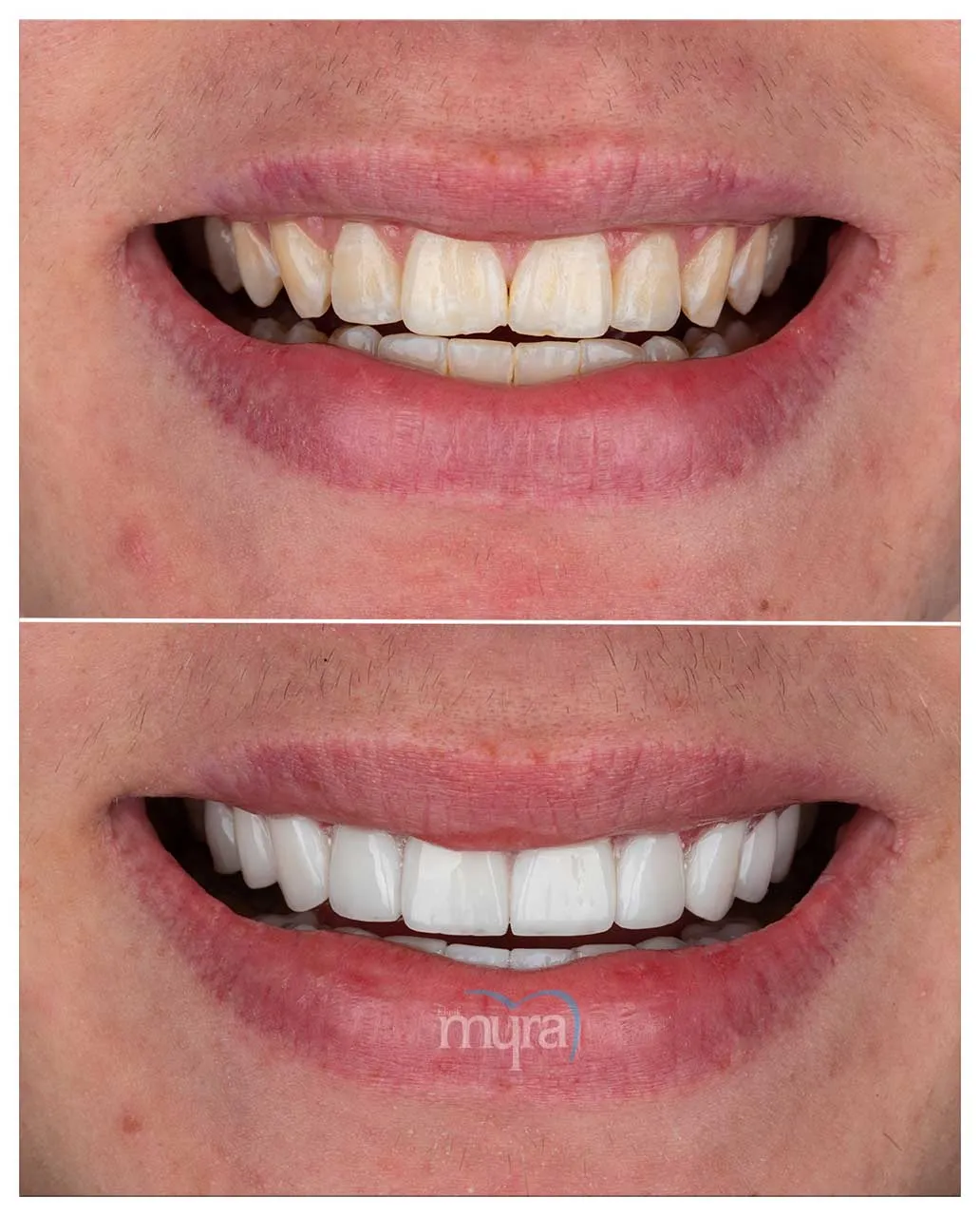 Myra Dental Centre Turkey -  Veneers Turkey