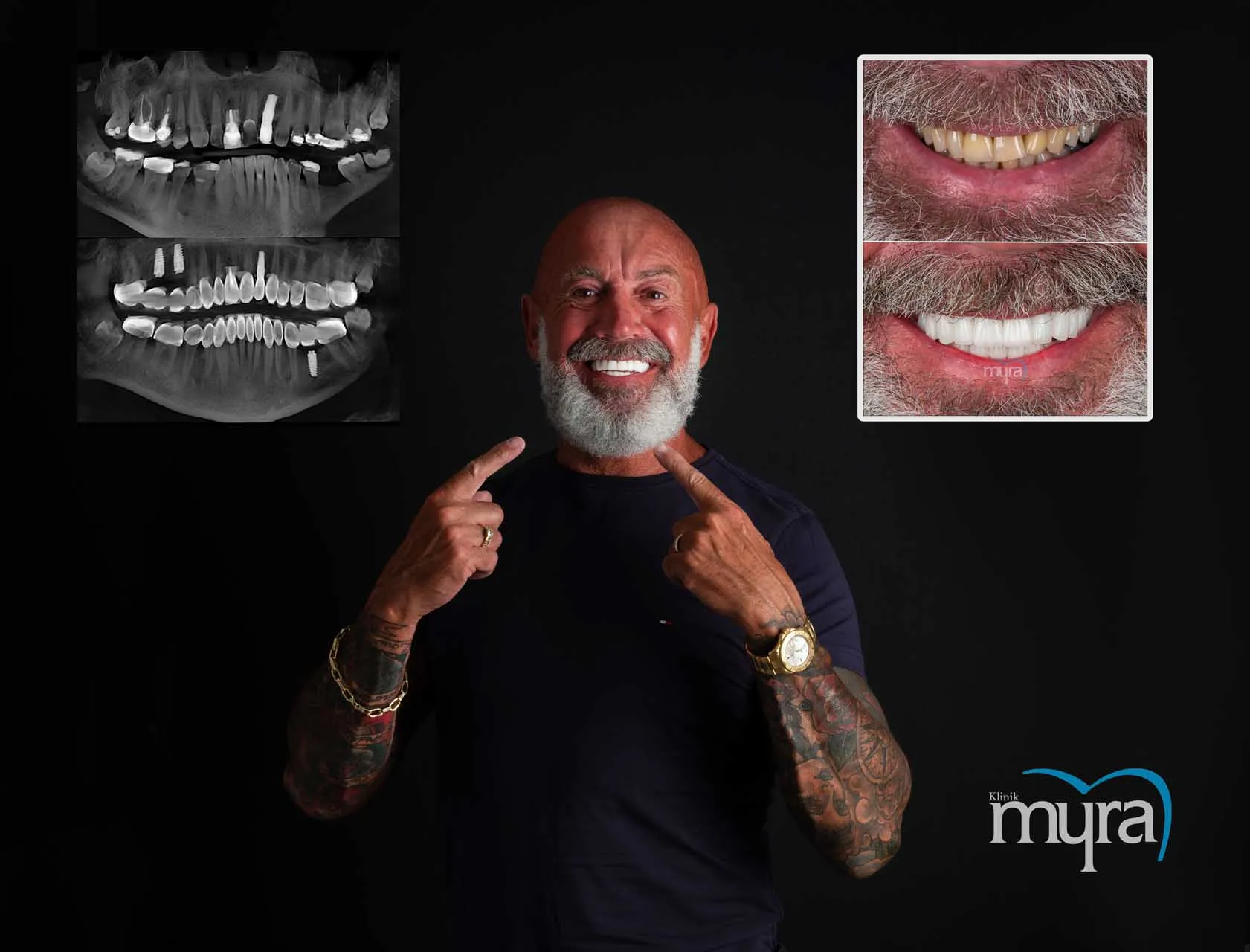 Myra Dental Centre Turkey - Dental Implants in Turkey