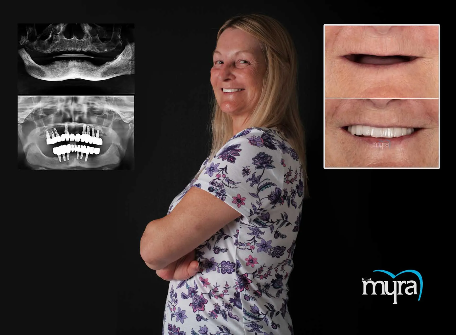 Myra Dental Centre Turkey - Dental Implants in Turkey