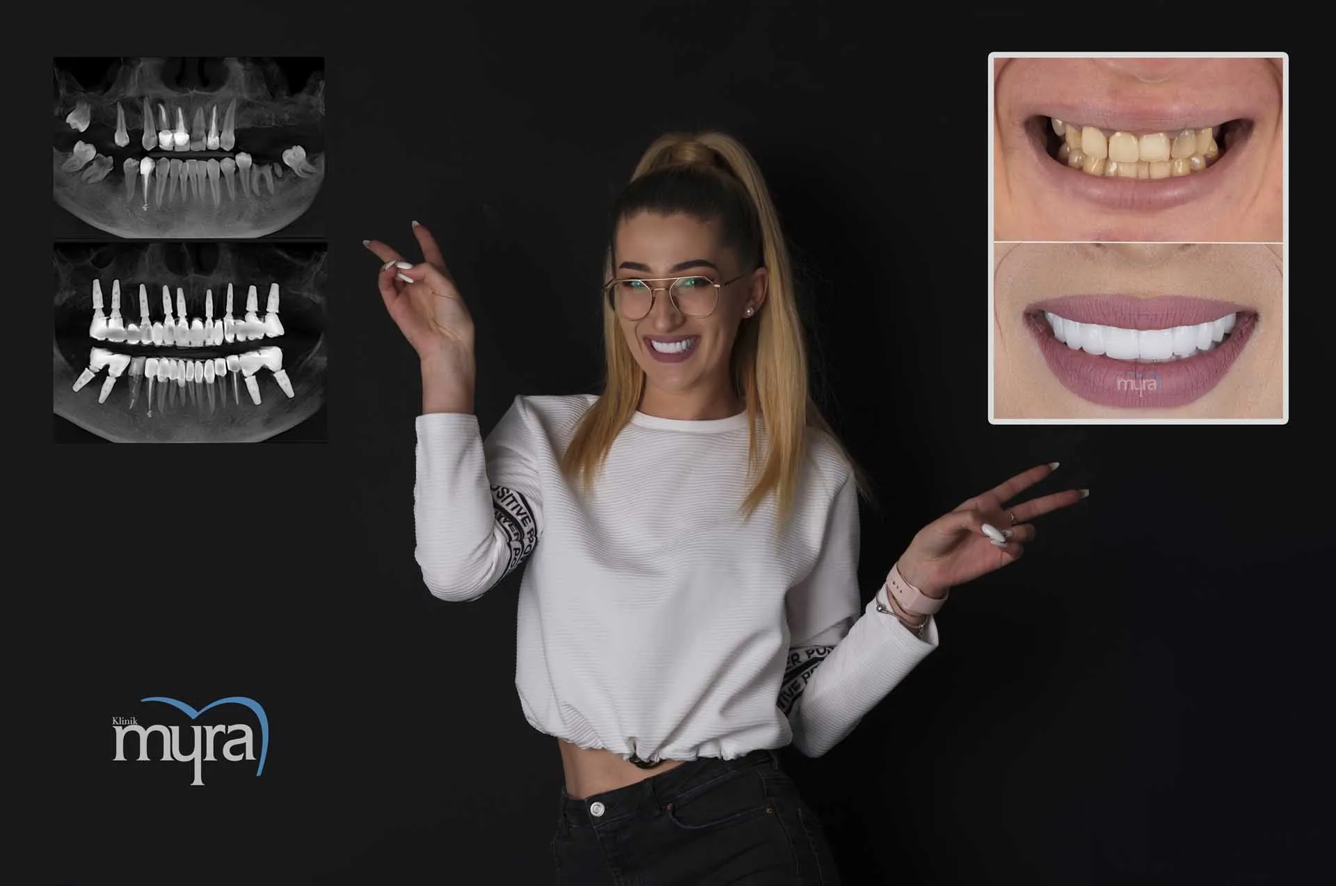 Myra Dental Centre Turkey - Dental Implants in Turkey