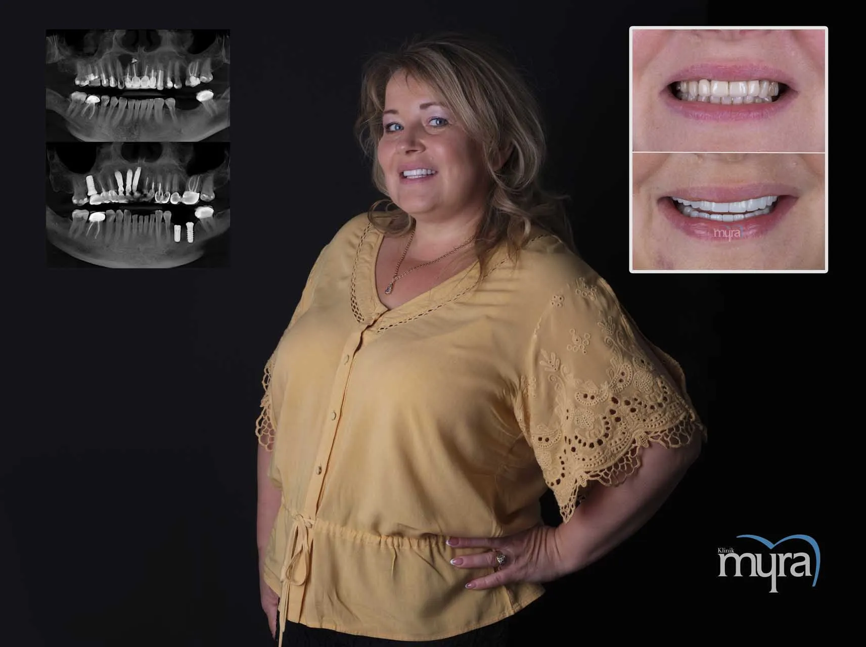 Myra Dental Centre Turkey - Dental Implants in Turkey