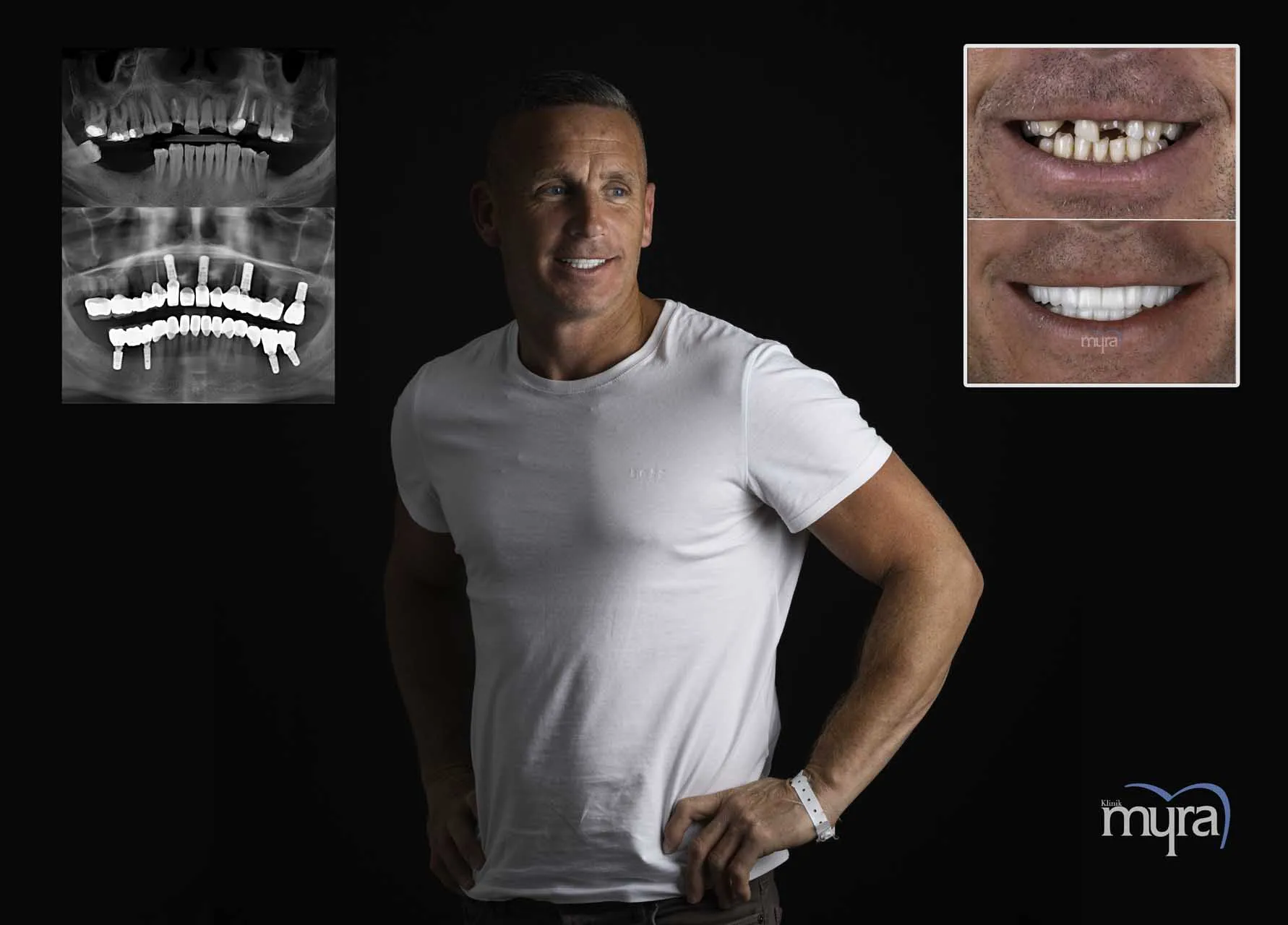 Myra Dental Centre Turkey - Dental Implants in Turkey