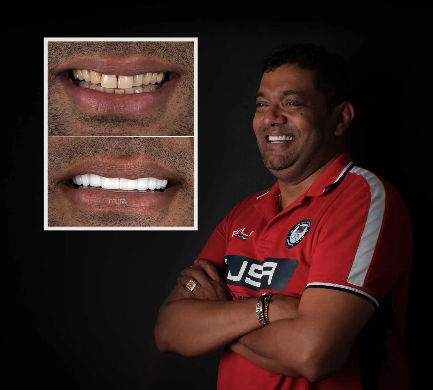 Myra Dental Centre Turkey -  Veneers Turkey