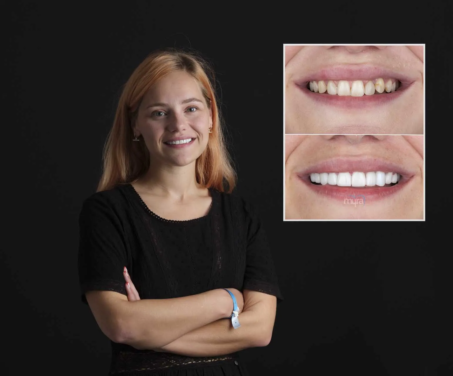 Myra Dental Centre Turkey -  Veneers Turkey