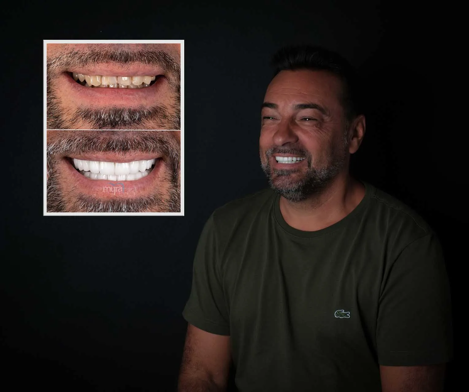 Myra Dental Centre Turkey -  Veneers Turkey