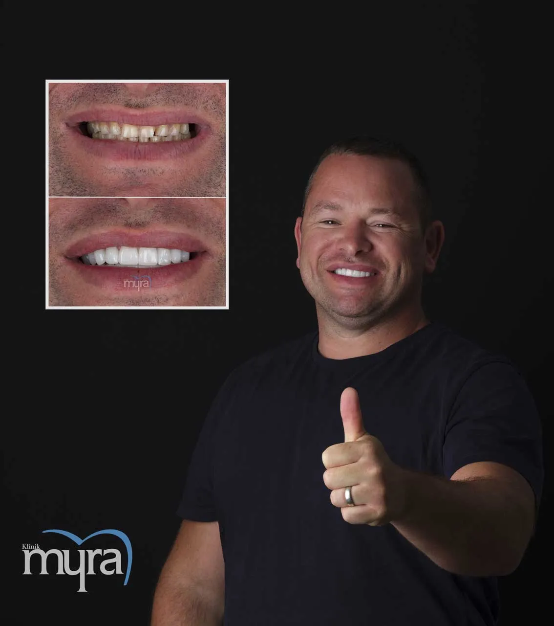 Myra Dental Centre Turkey -  Veneers Turkey
