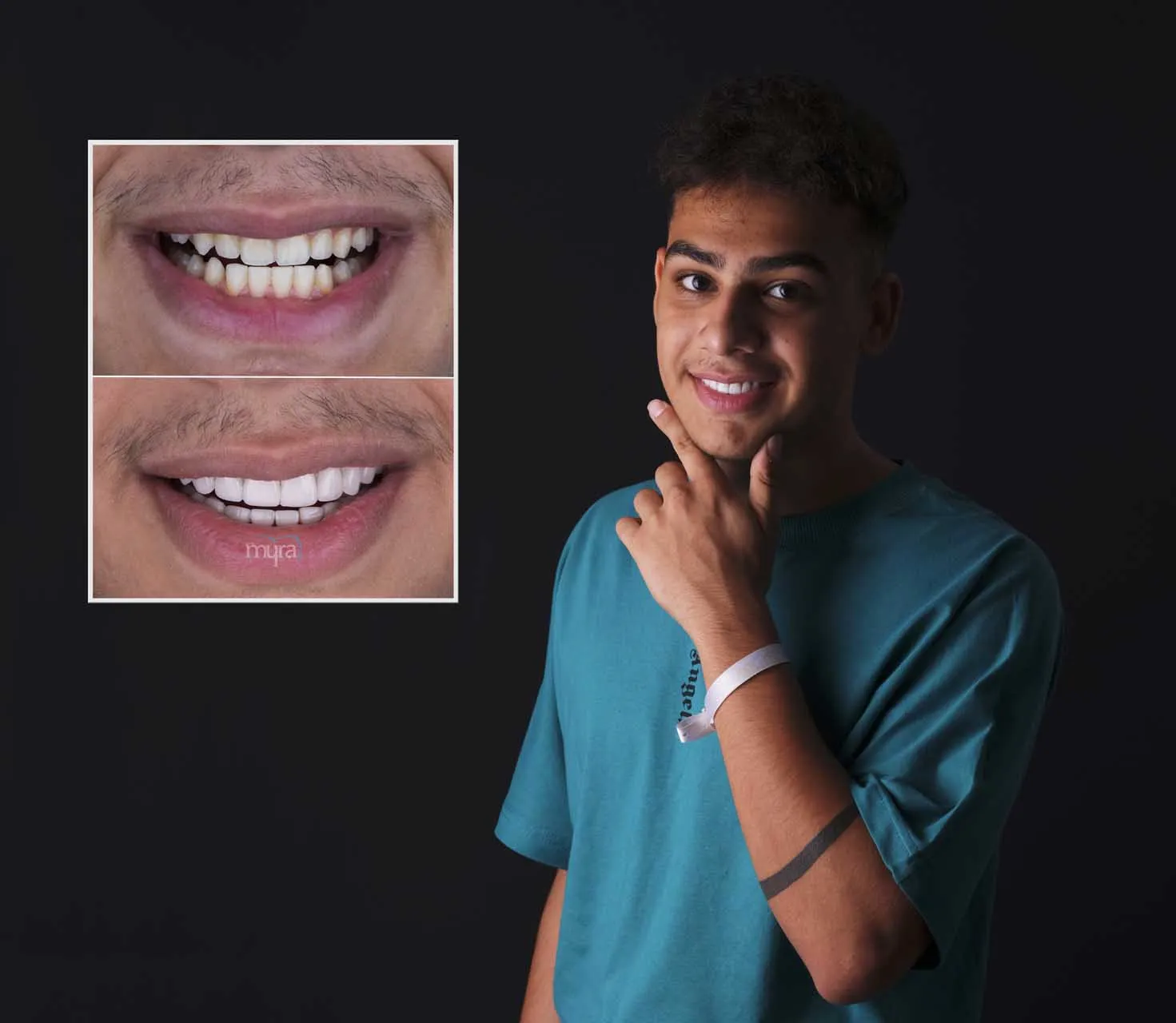 Myra Dental Centre Turkey -  Veneers Turkey
