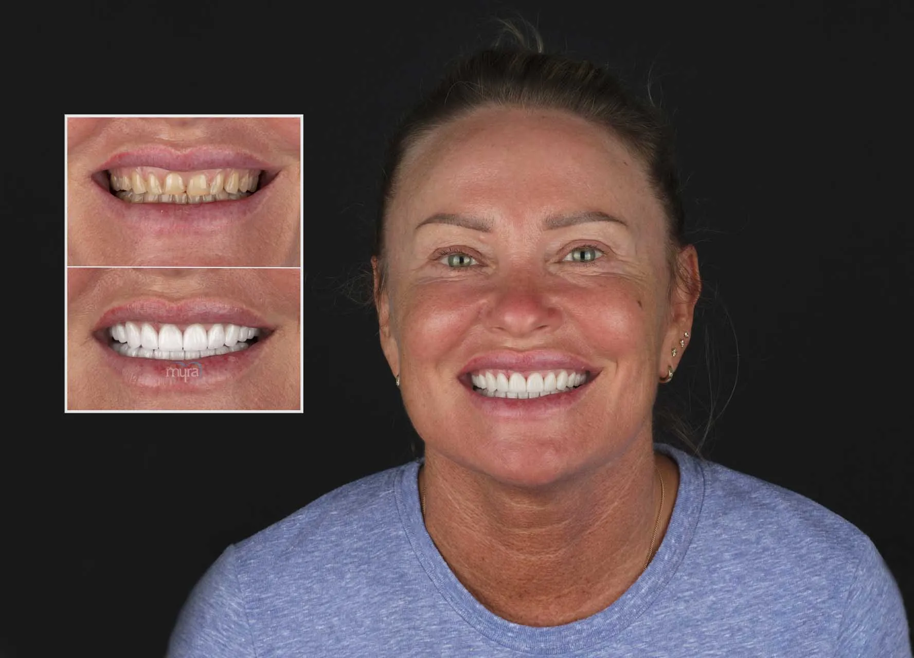 Myra Dental Centre Turkey -  Veneers Turkey