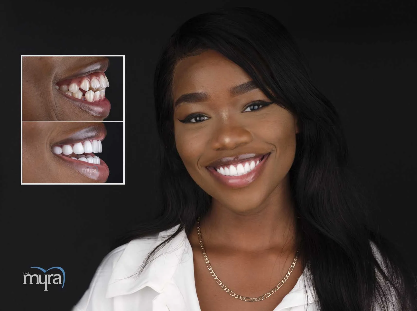 Myra Dental Centre Turkey -  Veneers Turkey