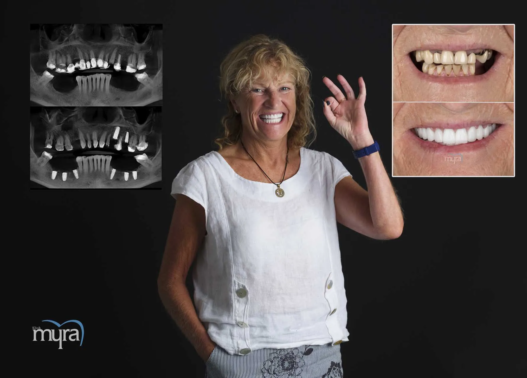 Myra Dental Centre Turkey - Dental Implants in Turkey