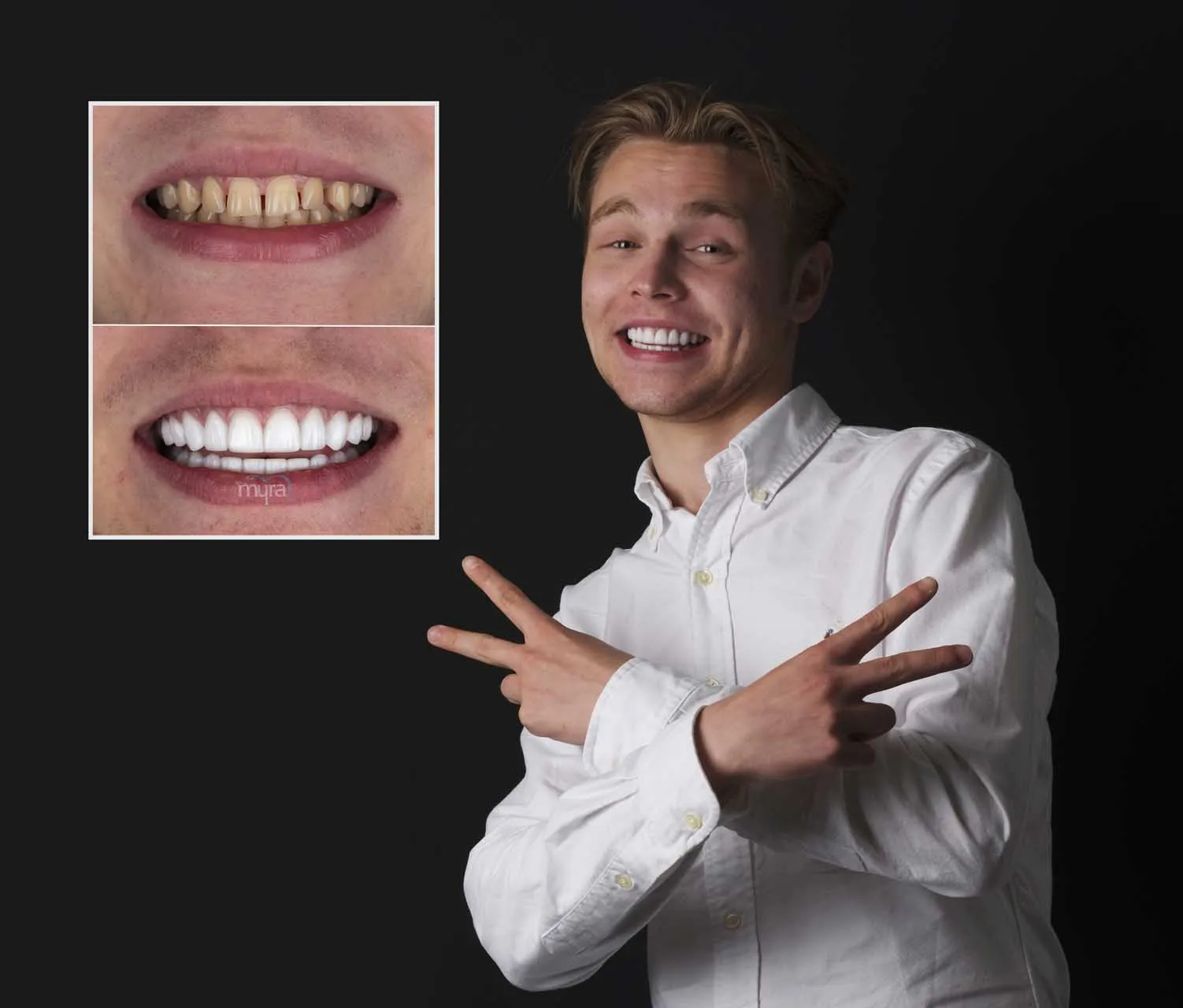 Myra Dental Centre Turkey -  Veneers Turkey