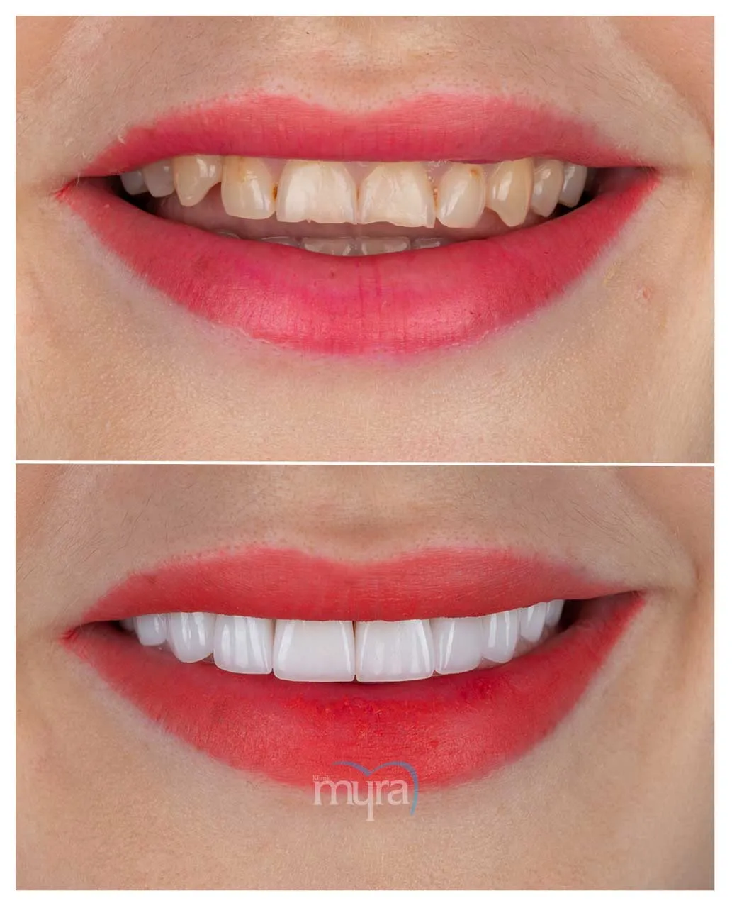 Myra Dental Centre Turkey -  Veneers Turkey