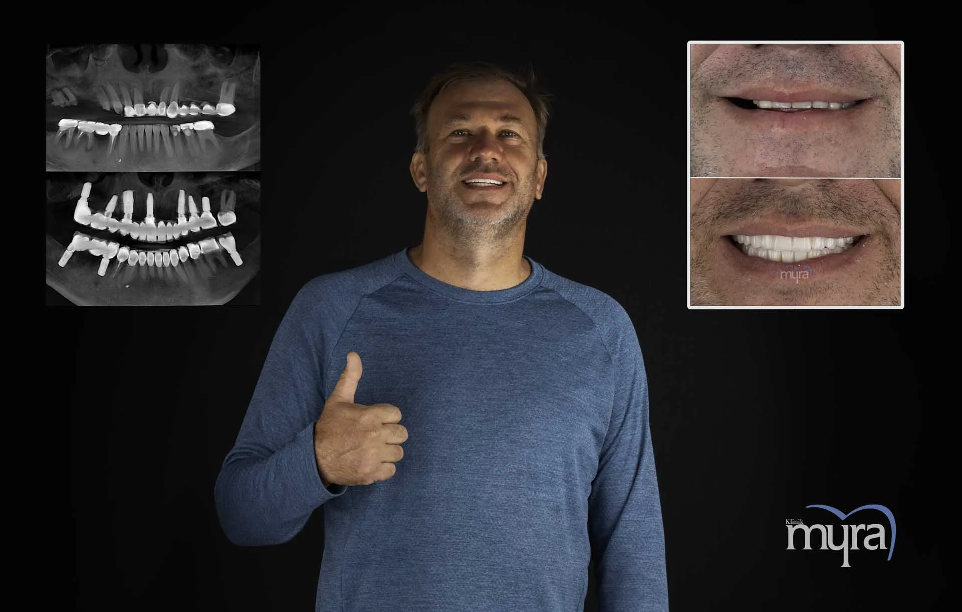Myra Dental Centre Turkey - Dental Implants in Turkey