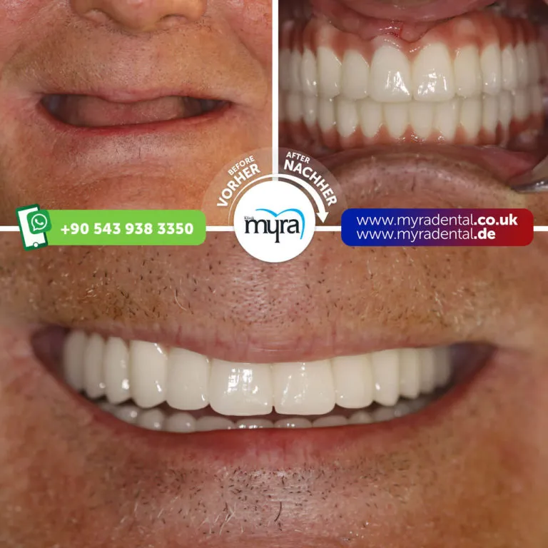 Myra Dental Centre Turkey - Dental Cosmetic Denture