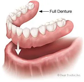 Myra Dental Centre Turkey - Dental Cosmetic Denture