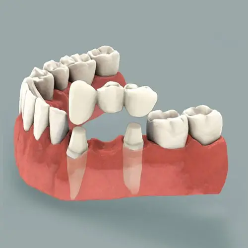 Myra Dental Centre Turkey - Dental Bridges in Turkey