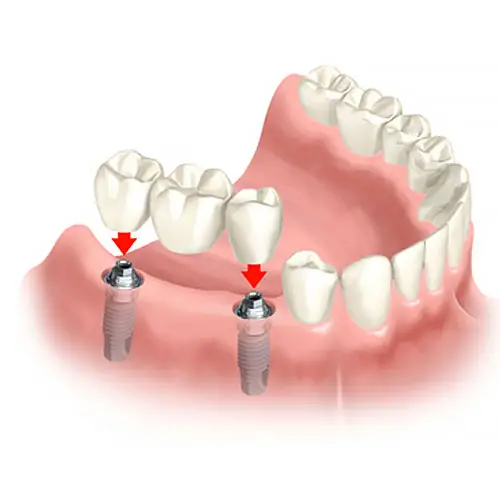 Myra Dental Centre Turkey - Dental Bridges in Turkey