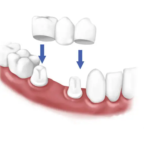 Myra Dental Centre Turkey - Dental Bridges in Turkey