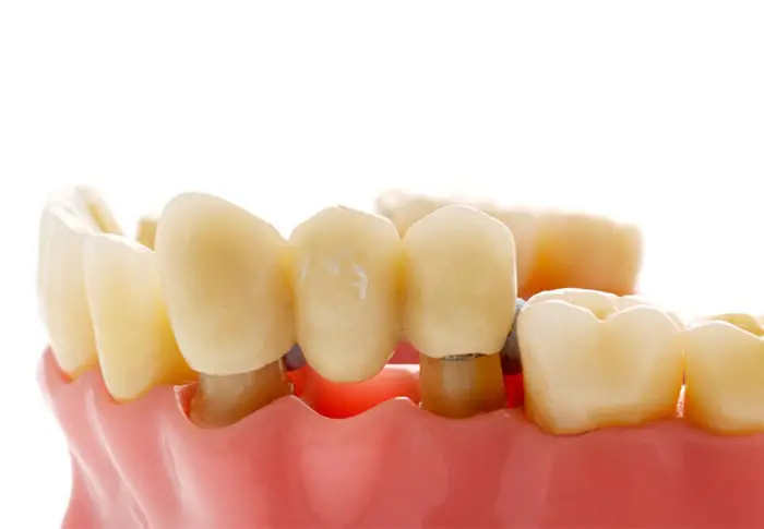 Myra Dental Centre Turkey - Dental Bridges in Turkey