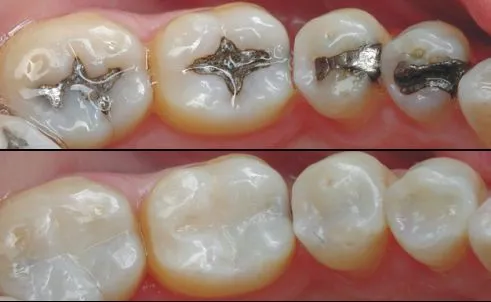 Myra Dental Centre Turkey - Dental Filling in Turkey