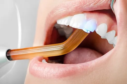 Myra Dental Centre Turkey - Dental Filling in Turkey