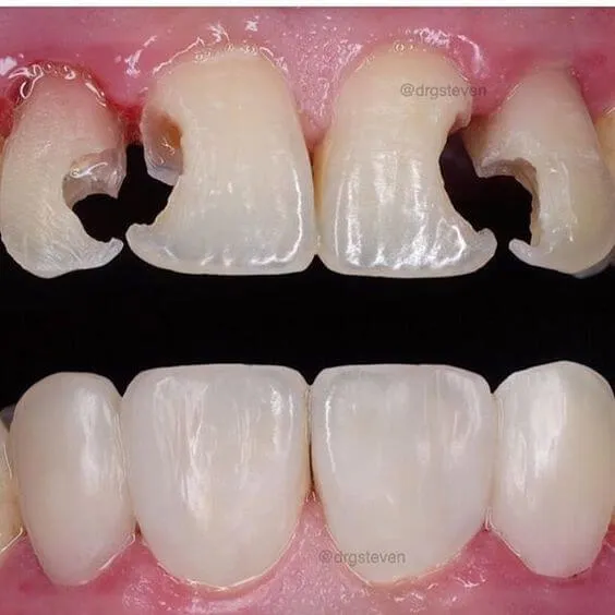 Myra Dental Centre Turkey - Dental Filling in Turkey