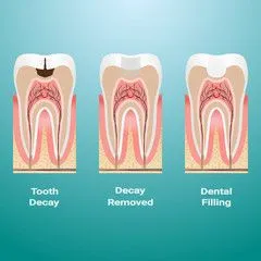 Myra Dental Centre Turkey - Dental Filling in Turkey
