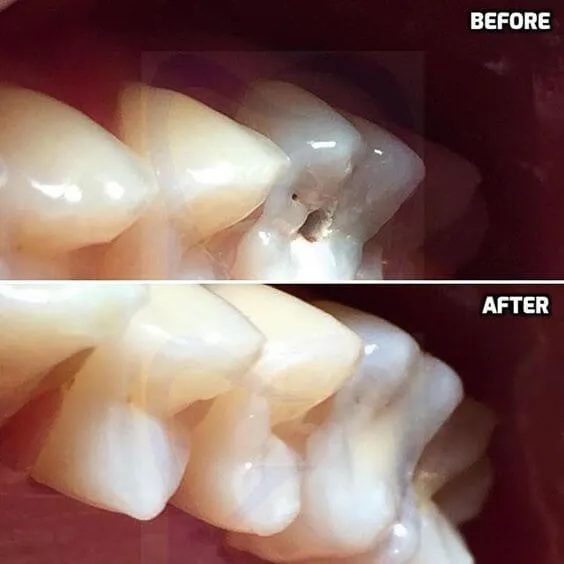 Myra Dental Centre Turkey - Dental Filling in Turkey