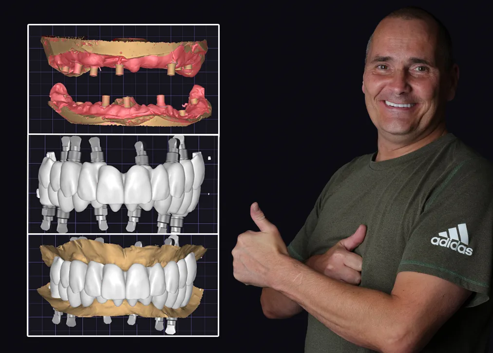 Dental Implants in Turkey