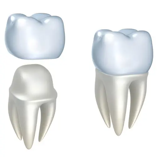 Myra Dental Centre Turkey - Dental Crowns - Veneers 