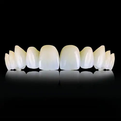 Myra Dental Centre Turkey - Emax Crowns