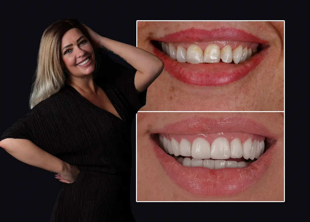 Gum Contouring in Turkey Definition Importance Types Procedure and Advantages