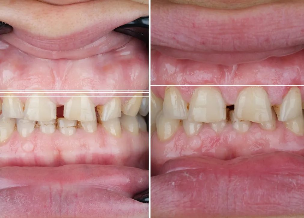 Gum Contouring in Turkey Definition Importance Types Procedure and Advantages