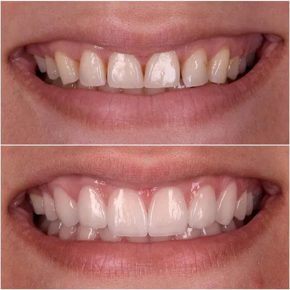 Myra Dental Centre Turkey - Gum Contouring 