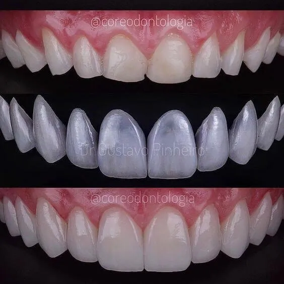 Myra Dental Centre Turkey - Gum Contouring in Turkey