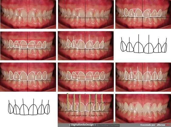 Myra Dental Centre Turkey - Gum Contouring in Turkey