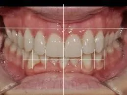 Myra Dental Centre Turkey - Gum Contouring in Turkey