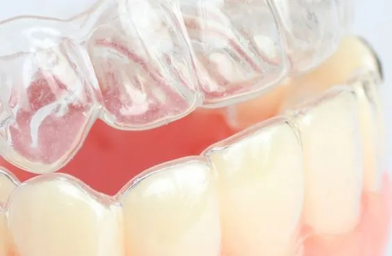Myra Dental Centre Turkey - Gum Shield in Turkey