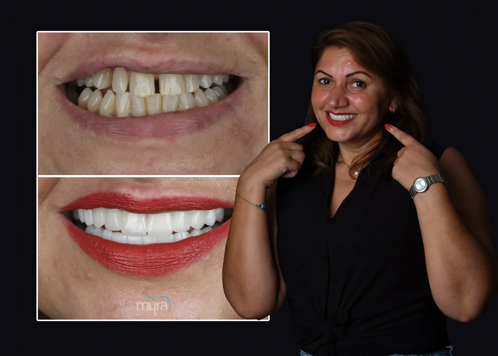 Gum Shield in Turkey Definition Importance Types Procedure and Advantages