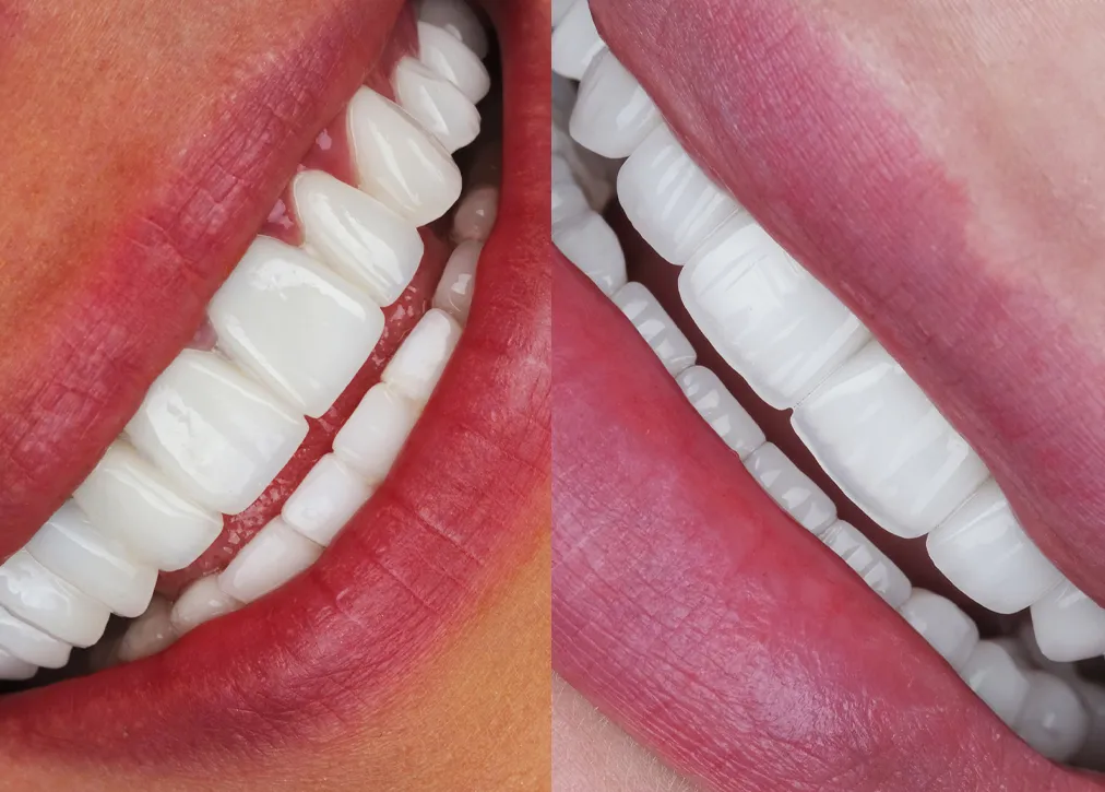 Hollywood Smile in Turkey Definition Importance Types Procedure and Advantages