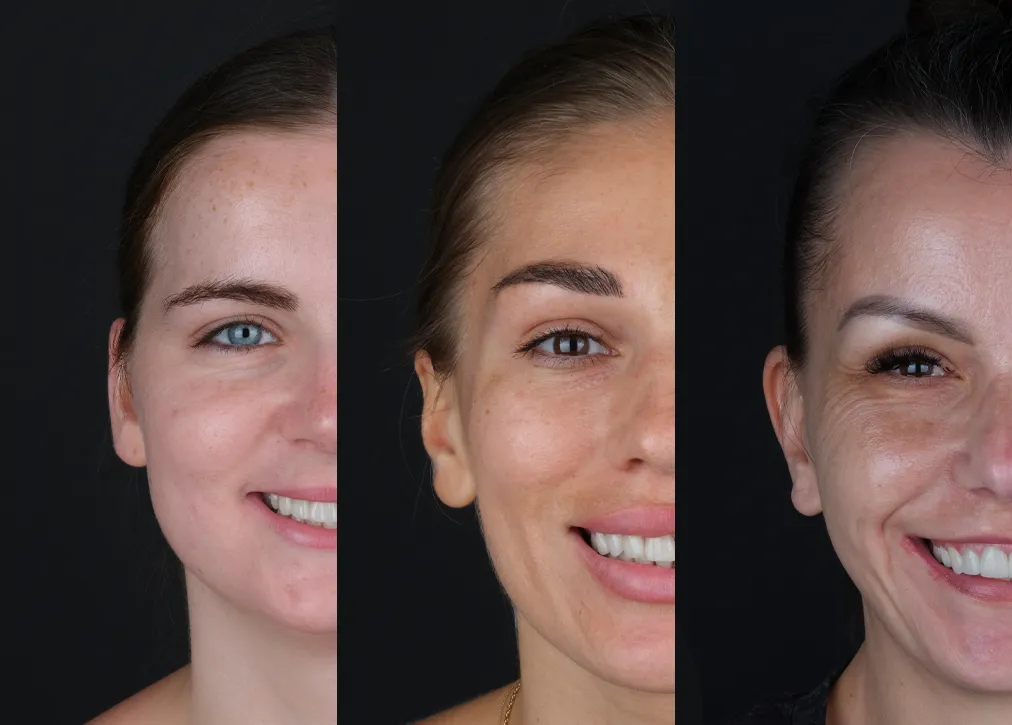 Hollywood Smile in Turkey Definition Importance Types Procedure and Advantages