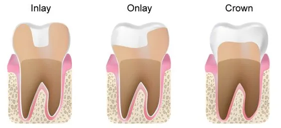Myra Dental Centre Turkey - Inlays and Onlays