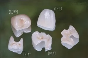 Myra Dental Centre Turkey - Inlays and Onlays