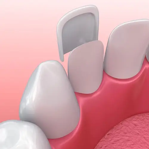 Myra Dental Centre Turkey - Dental Crowns - Veneers in Turkey 