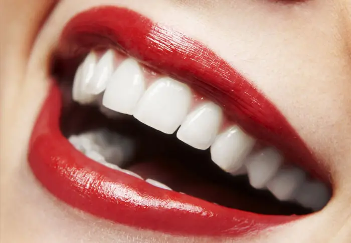 Myra Dental Centre Turkey - Laminate Veneers in Turkey