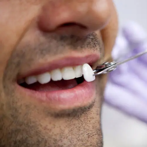 Myra Dental Centre Turkey - Laminate Veneers in Turkey