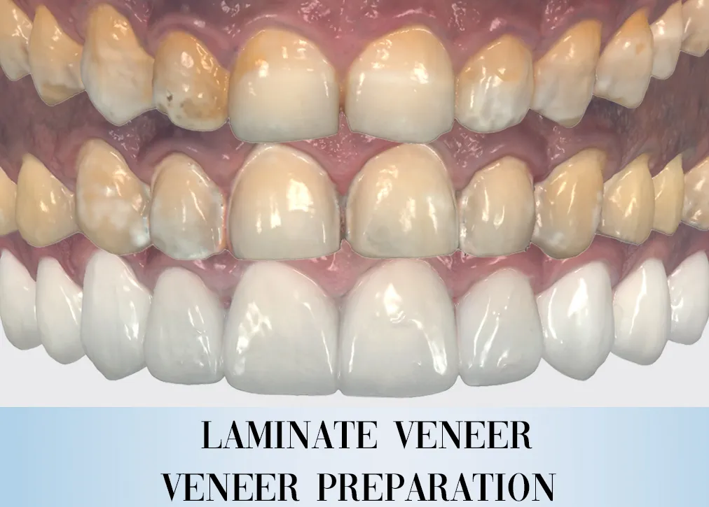 Laminate Veneers in Turkey Definition Importance Types Procedure and Advantages